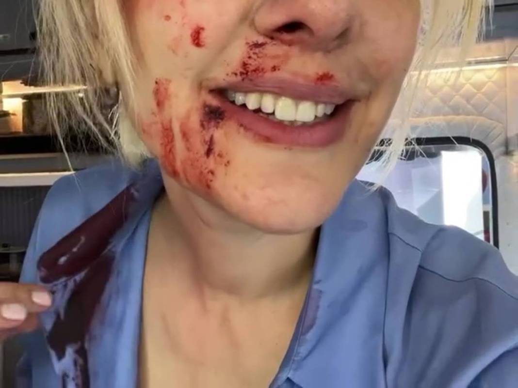 Bergüzar Korel'in kanlı paylaşımı takipçilerini korkuttu! Neden paylaştığı daha sonra ortaya çıktı 9